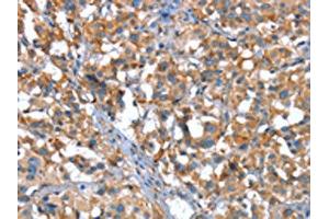 The image on the left is immunohistochemistry of paraffin-embedded Human thyroid cancer tissue using ABIN7190040(CACNA1G Antibody) at dilution 1/20, on the right is treated with synthetic peptide. (CACNA1G Antikörper)
