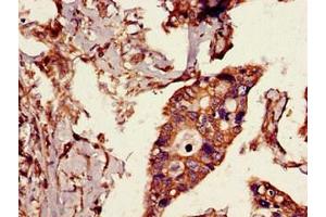 Immunohistochemistry of paraffin-embedded human pancreatic cancer using ABIN7174362 at dilution of 1:100