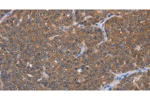 Immunohistochemistry of paraffin-embedded Human ovarian cancer using FABP6 Polyclonal Antibody at dilution of 1:30 (FABP6 Antikörper)