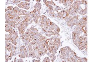 IHC-P Image Immunohistochemical analysis of paraffin-embedded NCIN87 xenograft , using PSAP, antibody at 1:500 dilution. (Prosaposin Antikörper)