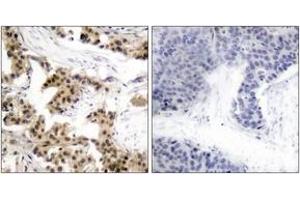 Immunohistochemistry analysis of paraffin-embedded human breast carcinoma, using NF-kappaB p105/p50 (Phospho-Ser893) Antibody. (NFKB1 Antikörper  (pSer893))