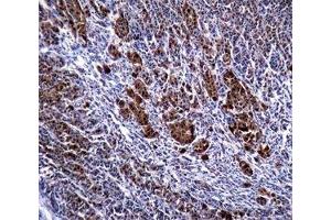 S100B antibody immunohistochemistry analysis in formalin fixed and paraffin embedded human malignant melanoma. (S100B Antikörper)