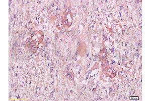 Formalin-fixed and paraffin embedded human endometrium carcinoma labeled with Anti-CGP-39/YKL-40 Polyclonal Antibody, Unconjugated at 1:300 followed by conjugation to the secondary antibody and DAB staining (CHI3L1 Antikörper  (AA 330-381))