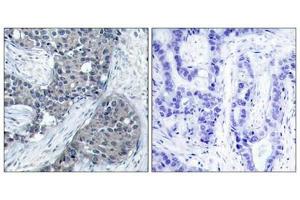 Immunohistochemical analysis of paraffin-embedded human breast carcinoma tissue using eIF4E(Phospho-Ser209) Antibody(left) or the same antibody preincubated with blocking peptide(right). (EIF4E Antikörper  (pSer209))