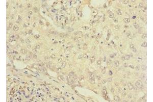 Immunohistochemistry of paraffin-embedded human lung cancer using ABIN7152656 at dilution of 1:100 (FCRL2 Antikörper  (AA 20-100))