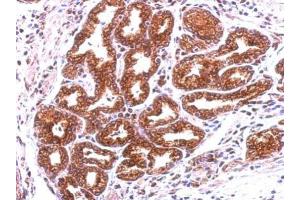 IHC-P Image Immunohistochemical analysis of paraffin-embedded human colon carcinoma, using Annexin A13, antibody at 1:500 dilution.