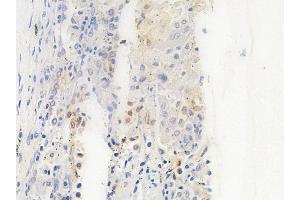 ABIN6263071 and ABIN6266879 at 1/100 staining human lung squamous cell carcinoma by IHC-P. (Melanoma Antigen Family D, 4 (MAGED4) (C-Term) Antikörper)
