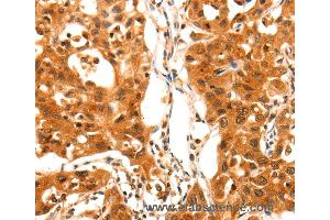 Immunohistochemistry of Human lung cancer using SERPINB5 Polyclonal Antibody at dilution of 1:60 (SERPINB5 Antikörper)