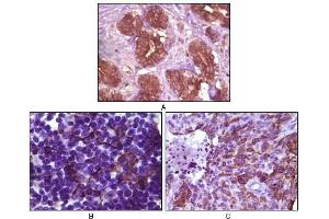 Immunohistochemical analysis of paraffin-embedded human breast tissue (A), lymph tissue (B) and skin carcinoma (C), showing membrane localization using BLK antibody with DAB staining. (BLK Antikörper)
