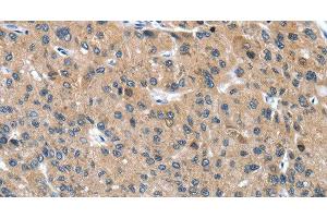 Immunohistochemistry of paraffin-embedded Human liver cancer tissue using DSC1 Polyclonal Antibody at dilution 1:40 (Desmocollin 1 Antikörper)