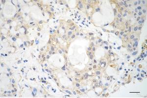 Immunohistochemistry was performed on paraffin-embedded human lung adenocarcinoma using vascular endothelial growth factor D antibody (ABIN7797810), 1:200).
