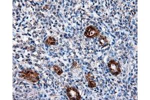 Immunohistochemical staining of paraffin-embedded Adenocarcinoma of colon tissue using anti-L1CAM mouse monoclonal antibody. (L1CAM Antikörper)