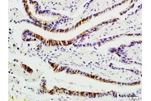 Formalin-fixed and paraffin-embedded : human colon carcinoma labeled with Rabbit Anti-Integrin αVβ1 Polyclonal Antibody , Unconjugated 1:200 followed by conjugation to the secondary antibody and DAB staining