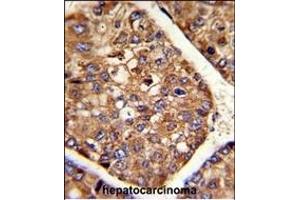 Formalin-fixed and paraffin-embedded human hepatocarcinoma reacted with P4HB Antibody (C-term), which was peroxidase-conjugated to the secondary antibody, followed by DAB staining. (P4HB Antikörper  (C-Term))