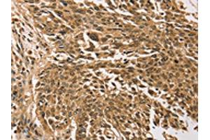 The image on the left is immunohistochemistry of paraffin-embedded Human lung cancer tissue using ABIN7192784(TGM7 Antibody) at dilution 1/30, on the right is treated with synthetic peptide. (Transglutaminase 7 Antikörper)