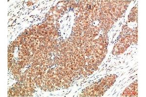 Immunohistochemical analysis of paraffin-embedded Human Breast Carcinoma Tissue using ATM Mouse mAb diluted at 1:200. (ATM Antikörper)