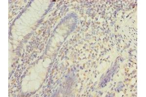 Immunohistochemistry of paraffin-embedded human colon cancer using ABIN7159710 at dilution of 1:100