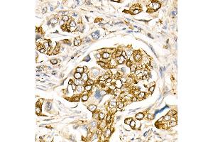 Immunohistochemistry of paraffin-embedded Human lung cancer using FasLG antibody (ABIN3020741, ABIN3020742, ABIN3020743, ABIN1512897 and ABIN6213701) at dilution of 1:150 (40x lens). (FASL Antikörper  (AA 100-200))