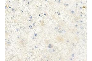 ABIN6258979 and ABIN6276065 at 1/100 staining human astrocytoma by IHC-P.
