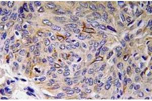 Immunohistochemistry (IHC) analyzes of IL-32 antibody in paraffin-embedded human lung carcinoma tissue. (IL32 Antikörper)