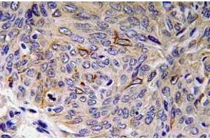 Immunohistochemistry (IHC) analyzes of IL-32 antibody in paraffin-embedded human lung carcinoma tissue. (IL32 Antikörper)