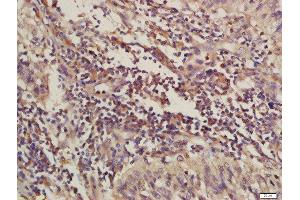 Formalin-fixed and paraffin embedded human laryngeal carcinoma labeled with Rabbit Anti-C4orf21 Polyclonal Antibody, Unconjugated (ABIN1714408) at 1:200 followed by conjugation to the secondary antibody and DAB staining (ZGRF1 Antikörper  (AA 101-200))
