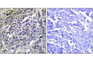 Immunohistochemistry analysis of paraffin-embedded human lung carcinoma tissue, using GRAK Antibody. (GZMK Antikörper  (AA 61-110))