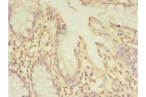 Immunohistochemistry of paraffin-embedded human colon cancer using ABIN7165911 at dilution of 1:100 (PELO Antikörper  (AA 1-385))