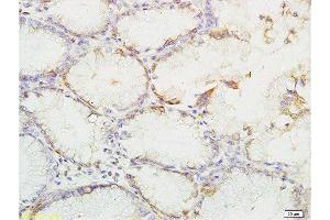 Formalin-fixed and paraffin embedded human gastric carcinoma labeled with Anti-phospho-YES1(Tyr426) Polyclonal Antibody, Unconjugated  at 1:200 followed by conjugation to the secondary antibody and DAB staining (YES1 Antikörper  (pTyr426))