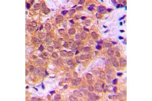 Immunohistochemical analysis of NF-kappaB p65 (pS468) staining in human breast cancer formalin fixed paraffin embedded tissue section.