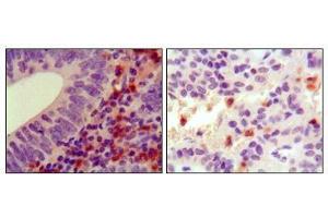 Immunohistochemical analysis of paraffin-embedded human colon cancer (left) and ancreas cancer (right), showing cytoplasmic localization using HCK antibody with DAB staining. (HCK Antikörper)