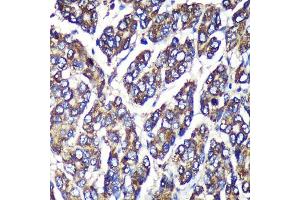 Immunohistochemistry of paraffin-embedded Human liver cancer using UGT1 Rabbit pAb (ABIN6132769, ABIN6149895, ABIN6149896 and ABIN6221779) at dilution of 1:100 (40x lens). (UGT1A1 Antikörper  (AA 1-200))