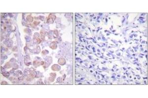 Immunohistochemistry analysis of paraffin-embedded human breast carcinoma tissue, using Synuclein (Ab-129) Antibody. (Synuclein Antikörper  (AA 91-140))