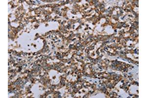 The image on the left is immunohistochemistry of paraffin-embedded Human liver cancer tissue using ABIN7191485(MMP23B Antibody) at dilution 1/20, on the right is treated with synthetic peptide. (MMP23A Antikörper)