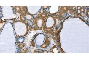 Immunohistochemistry of paraffin-embedded Human thyroid cancer using PPP2CA Polyclonal Antibody at dilution of 1:35 (PPP2CA Antikörper)