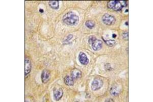 Formalin-fixed and paraffin-embedded human hepatocarcinoma tissue reacted with hCLDN1-Loop1, which was peroxidase-conjugated to the secondary antibody, followed by DAB staining.