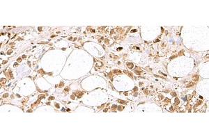 Immunohistochemistry of paraffin-embedded Human breast cancer tissue using RBFOX2 Polyclonal Antibody at dilution of 1:80(x200) (RBM9 Antikörper)