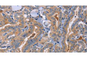 Immunohistochemistry of paraffin-embedded Human thyroid cancer using CD327 Polyclonal Antibody at dilution of 1:70 (SIGLEC6 Antikörper)