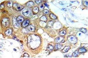 Immunohistochemistry (IHC) analyzes of c-RAF antibody in paraffin-embedded human breast carcinoma tissue. (RAF1 Antikörper)