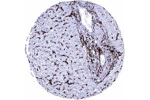 Liver Intense HLA DRB1 staining of inflammatory cells and of Kupffer cells HLA DRB1 immunohistochemistry (Rekombinanter HLA-DRB1 Antikörper)