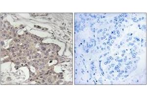 Immunohistochemistry analysis of paraffin-embedded human breast carcinoma tissue, using HIBADH Antibody. (HIBADH Antikörper  (AA 281-330))