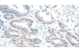 Immunohistochemistry of paraffin-embedded Human colon cancer using ALDH1A2 Polyclonal Antibody at dilution of 1:60