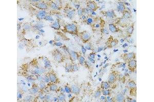 Immunohistochemistry of paraffin-embedded Human breast cancer using PSMD10 Polyclonal Antibody at dilution of 1:100 (40x lens). (PSMD10 Antikörper)