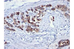 Formalin-fixed, paraffin-embedded human Gastric Carcinoma stained with CDC20 Mouse Monoclonal Antibody (AR12). (CDC20 Antikörper)
