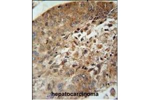 ACD10 Antibody (Center) (ABIN654760 and ABIN2844444) immunohistochemistry analysis in formalin fixed and paraffin embedded human hepatocarcinoma followed by peroxidase conjugation of the secondary antibody and DAB staining. (ACAD10 Antikörper  (AA 393-421))