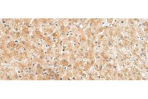 Immunohistochemistry of paraffin-embedded Human liver cancer tissue using ZNF185 Polyclonal Antibody at dilution of 1:25(x200) (Zinc Finger Protein 185 Antikörper)