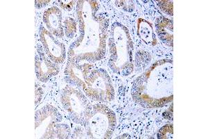 Immunohistochemical analysis of MKK1/2 (pS222/226) staining in human colon cancer formalin fixed paraffin embedded tissue section. (MEK1 Antikörper  (pSer222, pSer226))