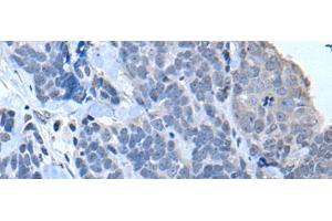 Immunohistochemistry of paraffin-embedded Human thyroid cancer tissue using TIA1 Polyclonal Antibody at dilution of 1:30(x200) (TIA1 Antikörper)