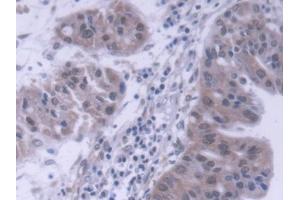 DAB staining on IHC-P; Samples: Human Liver cancer Tissue (DP1 Antikörper  (AA 6-410))