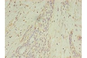 Immunohistochemistry of paraffin-embedded human breast cancer using ABIN7159252 at dilution of 1:100 (MAGEA1 Antikörper  (AA 2-225))